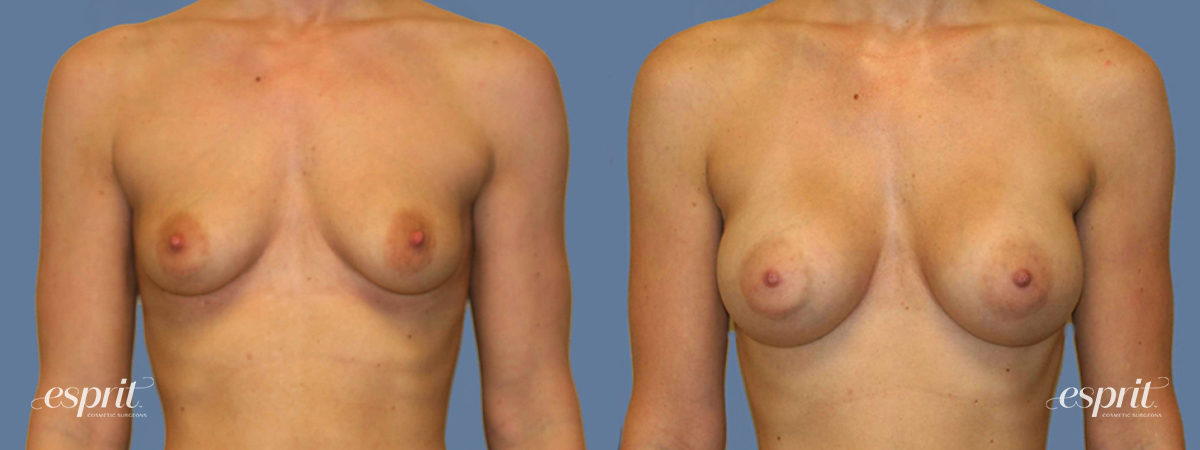 Case 1265 before and after front view esprit® cosmetic surgeons