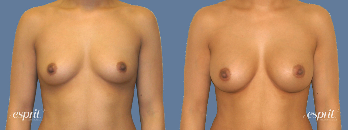 Case 1271 before and after front view esprit® cosmetic surgeons