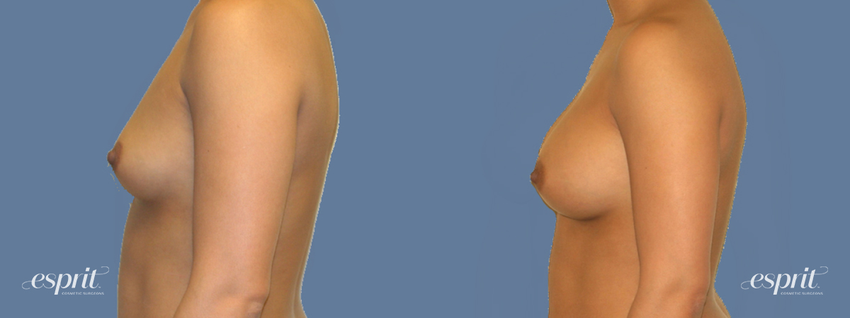 Case 1271 before and after left side view esprit® cosmetic surgeons