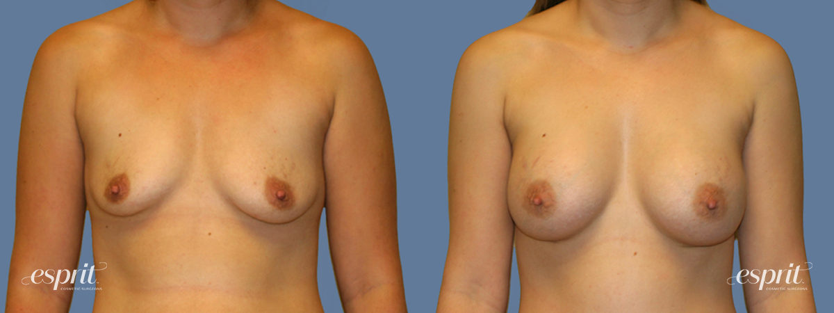 Case 1273 before and after front view esprit® cosmetic surgeons