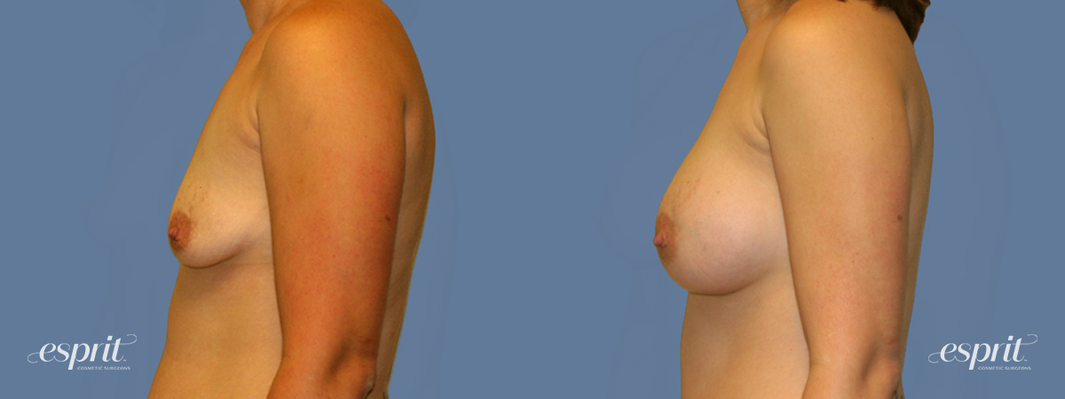 Case 1273 before and after left side view esprit® cosmetic surgeons