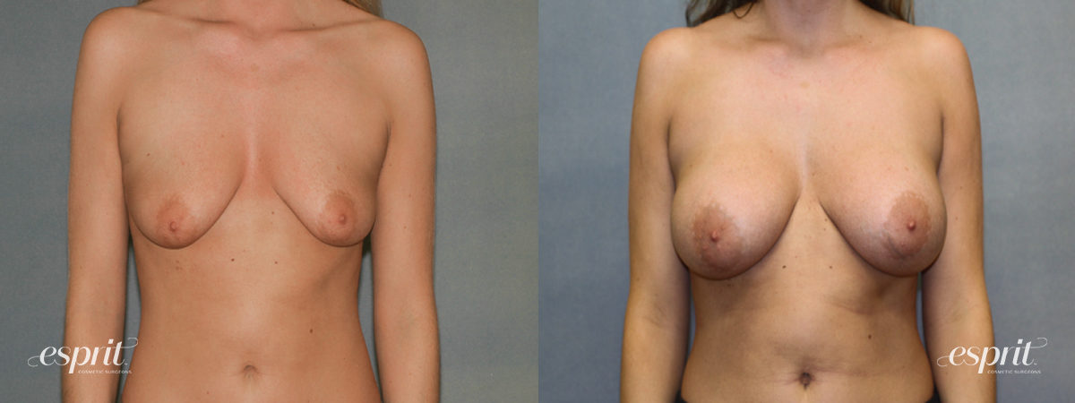 Case 1339 before and after front view esprit® cosmetic surgeons