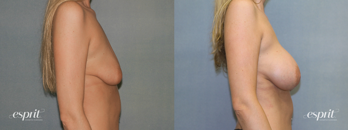 Case 1339 before and after right side view esprit® cosmetic surgeons