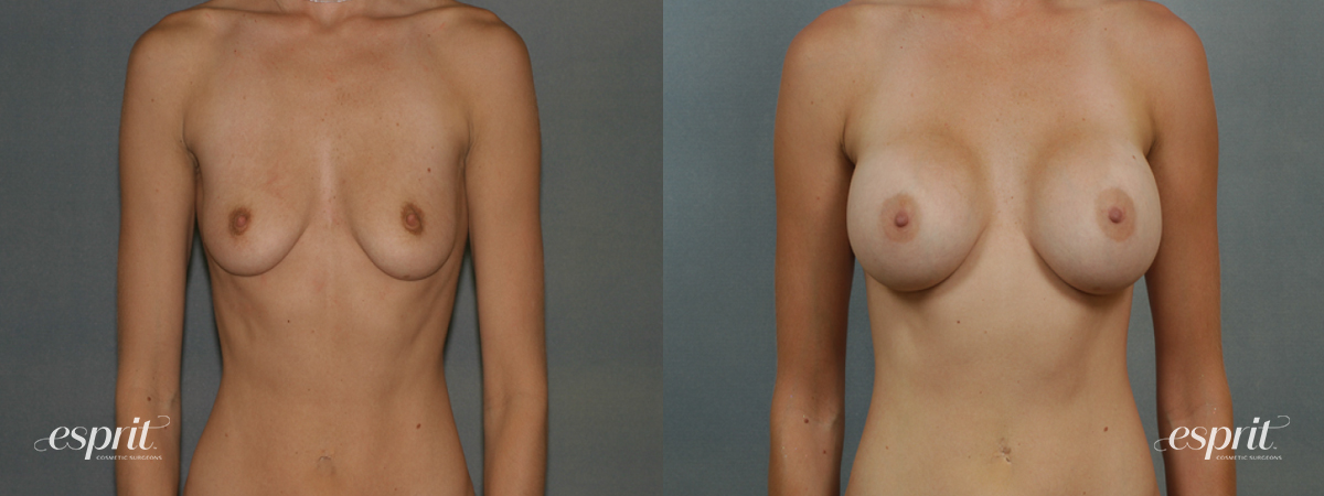 Case 1341 before and after front view esprit® cosmetic surgeons