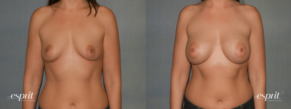 Case 1346 before and after front view esprit® cosmetic surgeons