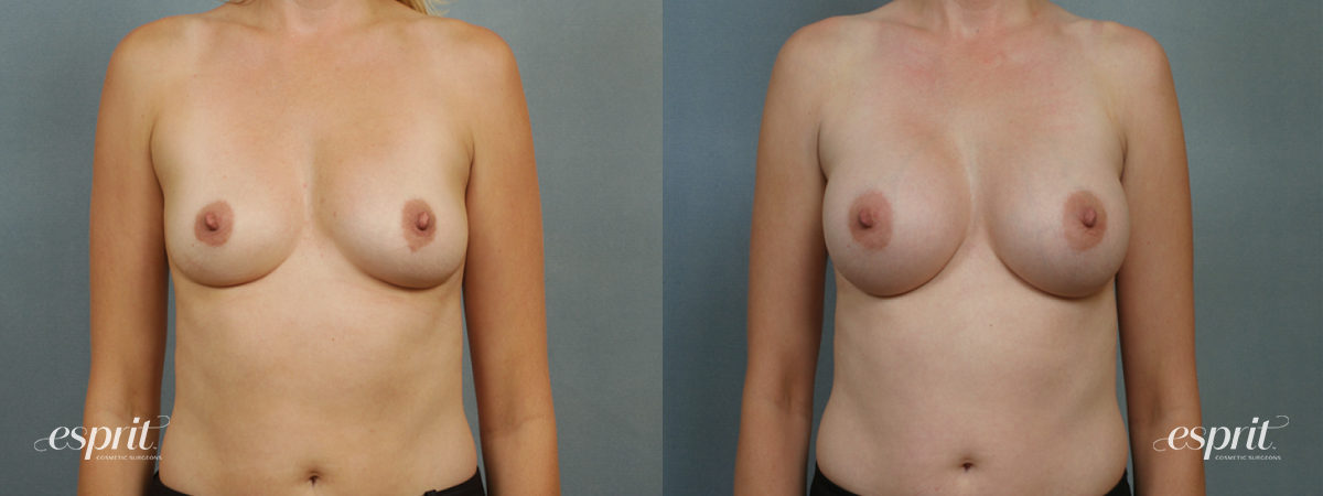 Case 1348 before and after front view esprit® cosmetic surgeons