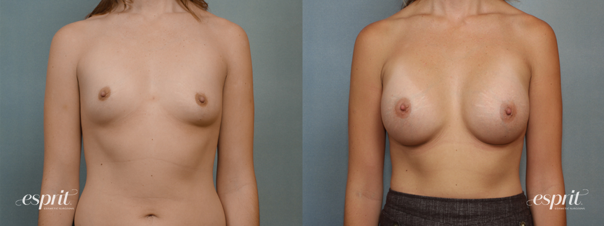 Case 1391 before and after front view esprit® cosmetic surgeons