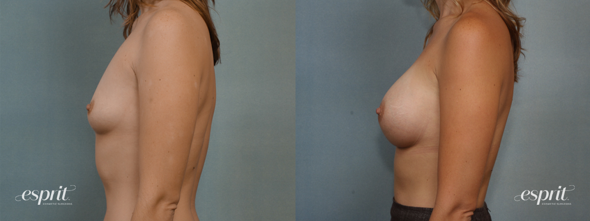 Case 1391 before and after left side view esprit® cosmetic surgeons