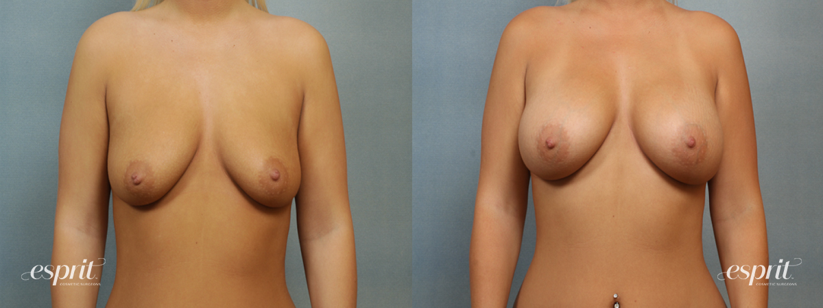 Case 1417 before and after front view esprit® cosmetic surgeons
