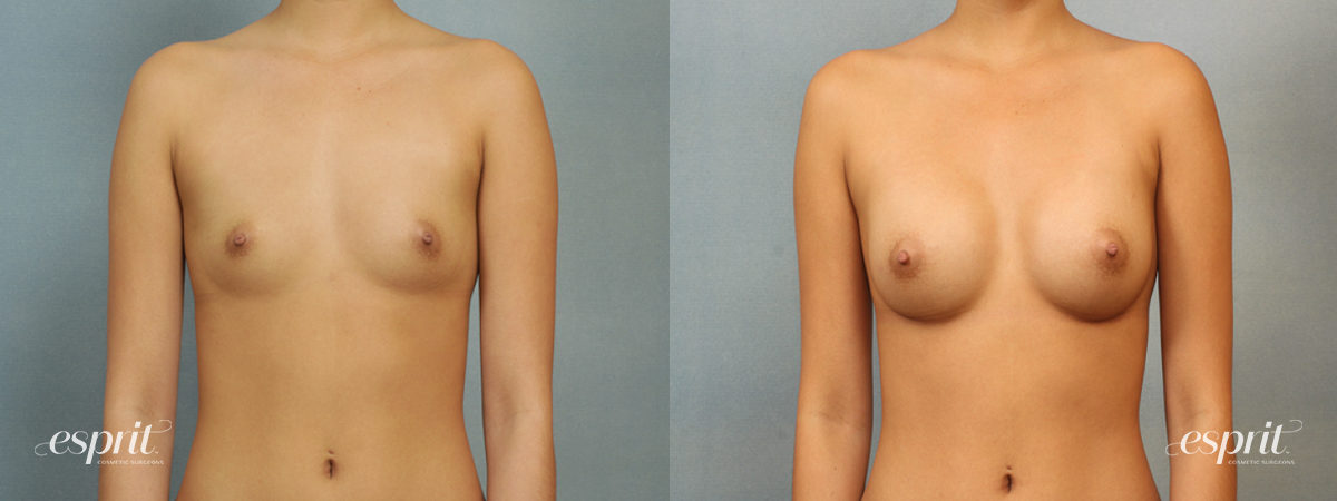 Case 1418 before and after front view esprit® cosmetic surgeons