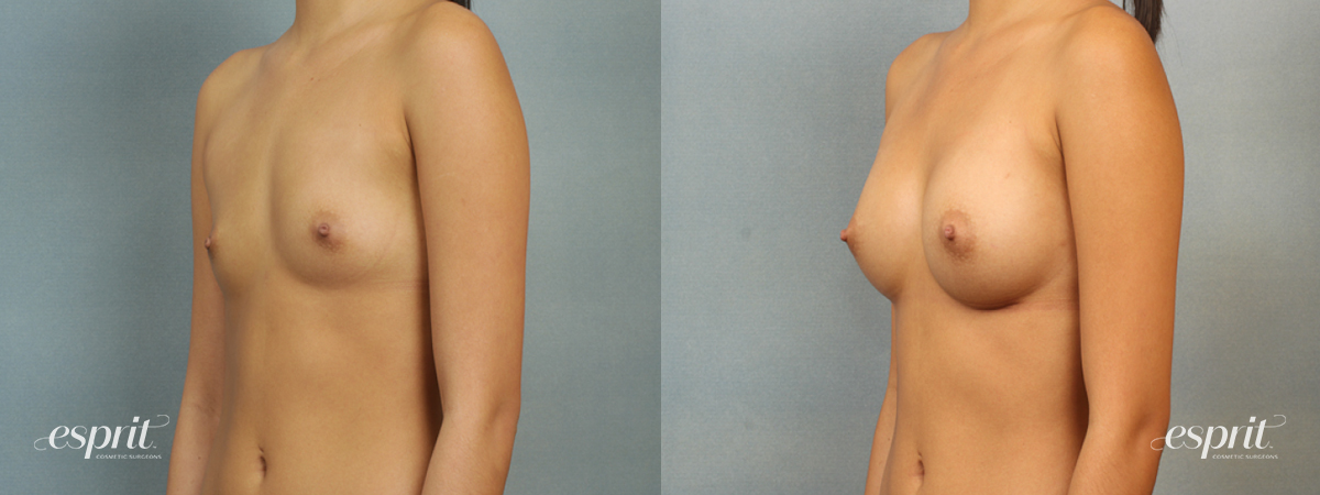 Case 1418 before and after left oblique view esprit® cosmetic surgeons