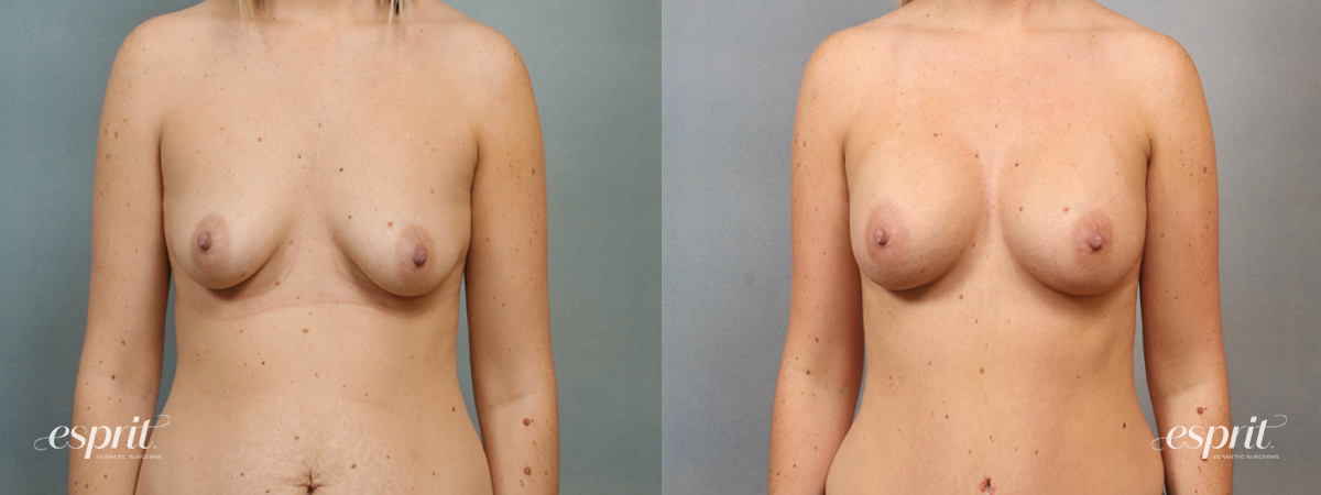 Case 1419 before and after front view esprit® cosmetic surgeons
