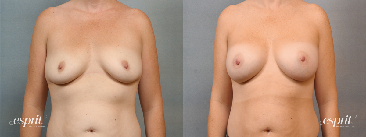 Case 1421 before and after front view esprit® cosmetic surgeons