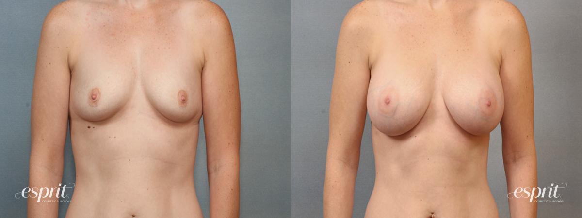 Case 1430 before and after front view esprit® cosmetic surgeons