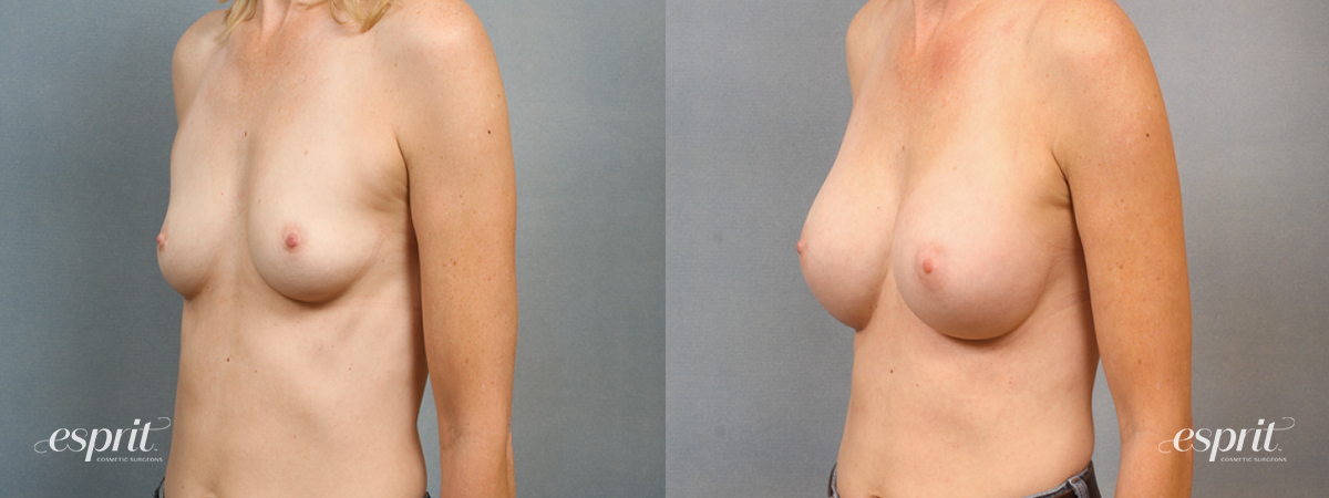 Case 1436 Before and After Left Oblique View