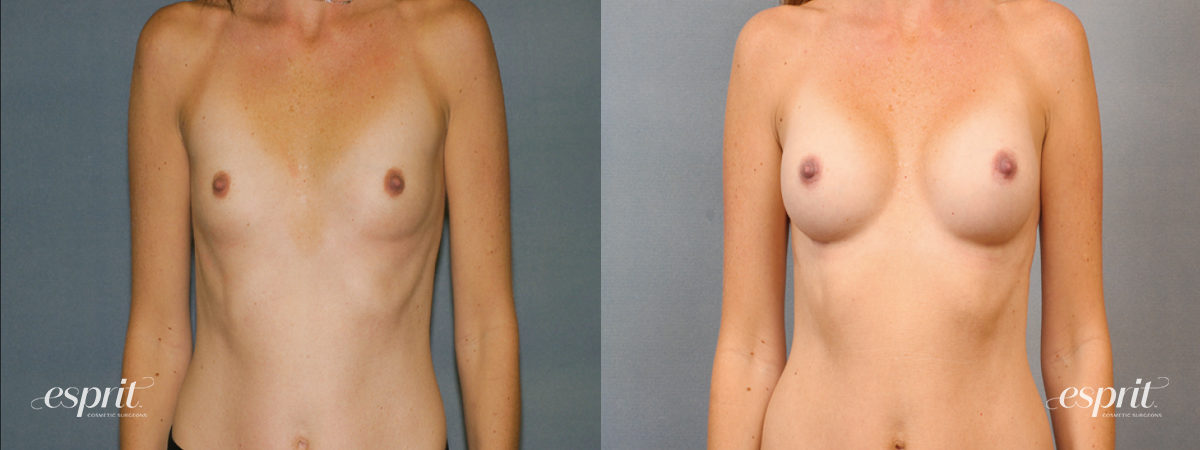 Case 1437 before and after front view esprit® cosmetic surgeons