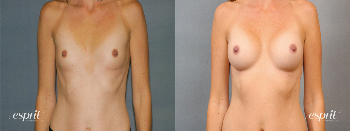 Case 1437 before and after front view esprit® cosmetic surgeons