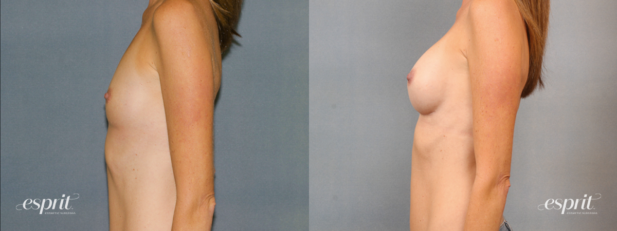 Case 1437 before and after left side view esprit® cosmetic surgeons