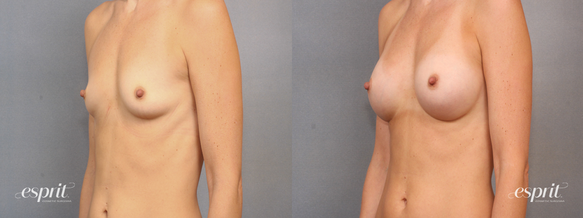 Case 1604 Before and After Left Oblique View
