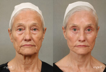 Case 3103 before and after front view esprit® cosmetic surgeons