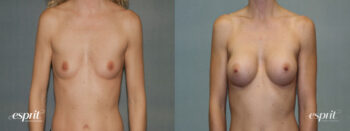 Breast Augmentation 1338, Front