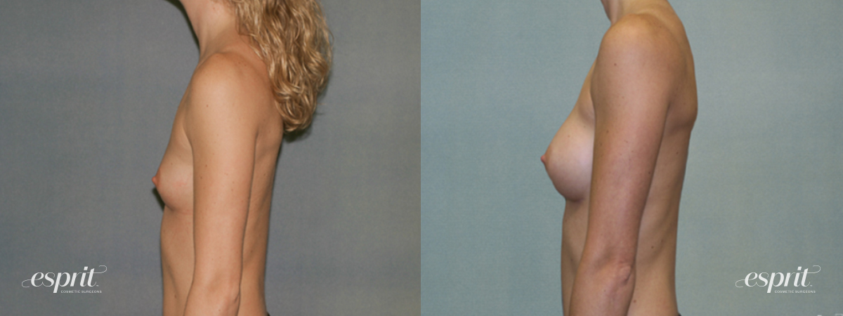 Breast Augmentation 1338, Oblique