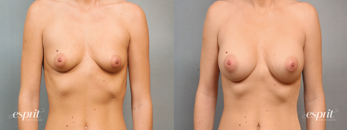 Case 1473 before and after front view esprit® cosmetic surgeons