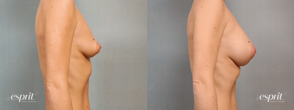 Case 1473 before and after right side view esprit® cosmetic surgeons