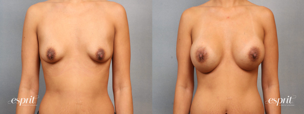 Case 1507 before and after front view esprit® cosmetic surgeons