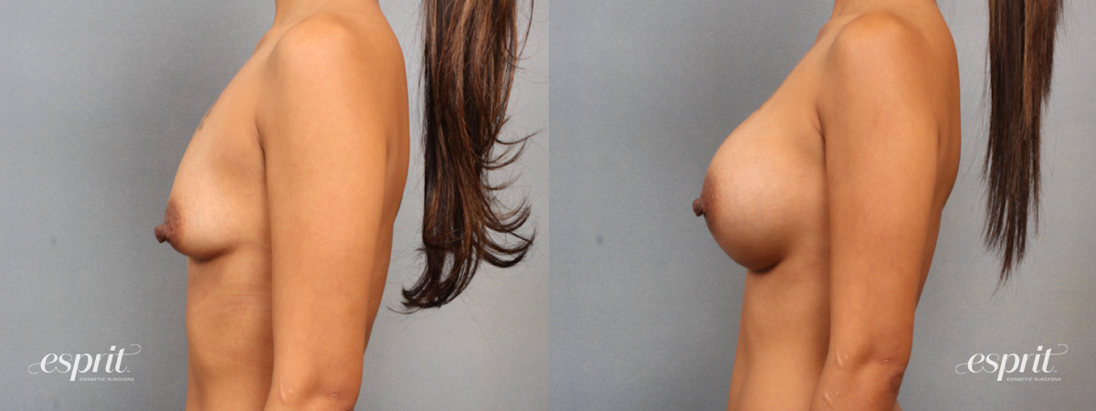 Case 1507 before and after left side view esprit® cosmetic surgeons
