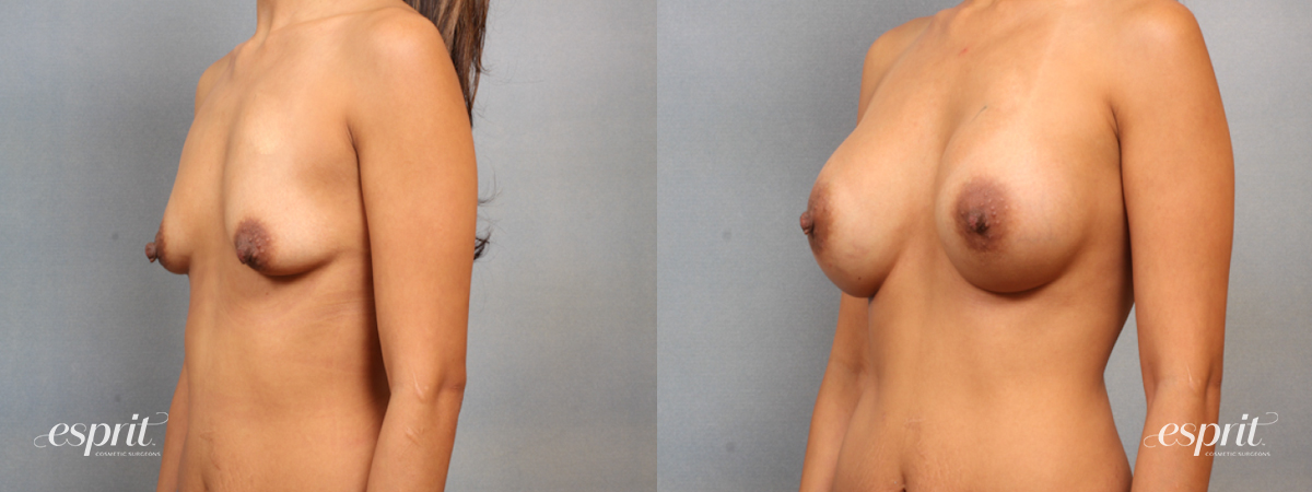 Case 1507 before and after left oblique view esprit® cosmetic surgeons