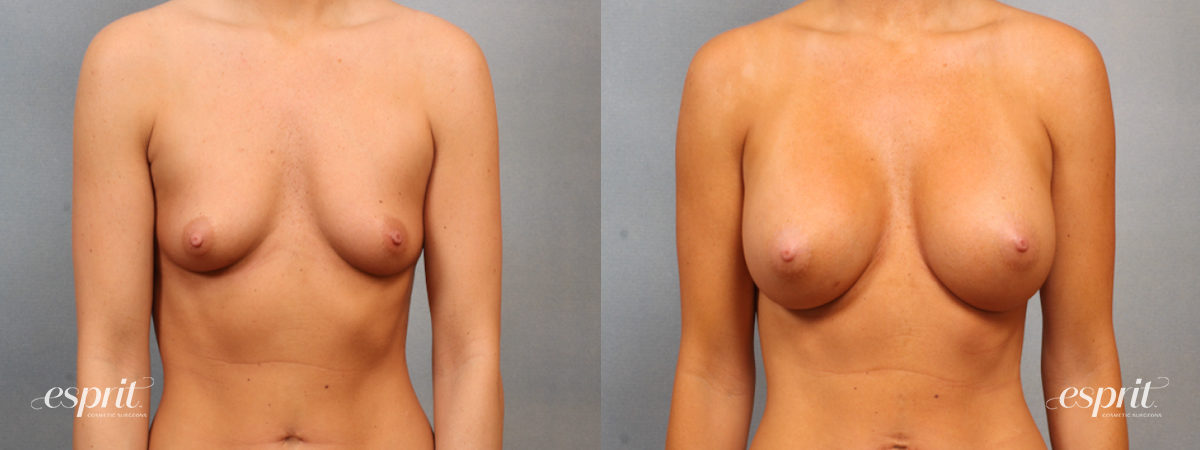 Case 1512 before and after front view esprit® cosmetic surgeons