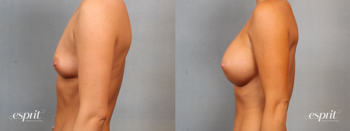 Case 1512 before and after left side view esprit® cosmetic surgeons