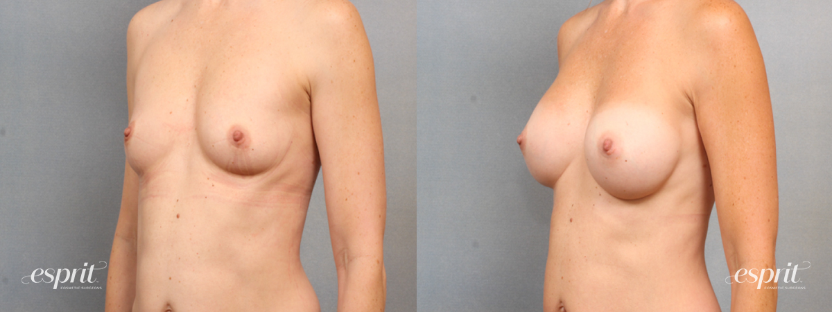 Case 1518 Before and After Left Oblique View