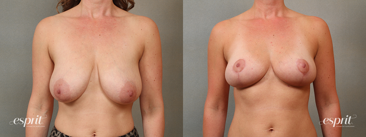Case 1431 Breast Reduction Before and After Front View