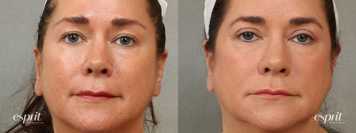 Case 1706 eyelids before and after front view esprit® cosmetic surgeons