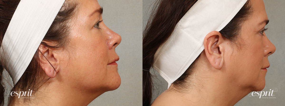 Case 1706 eyelids before and after right side view esprit® cosmetic surgeons