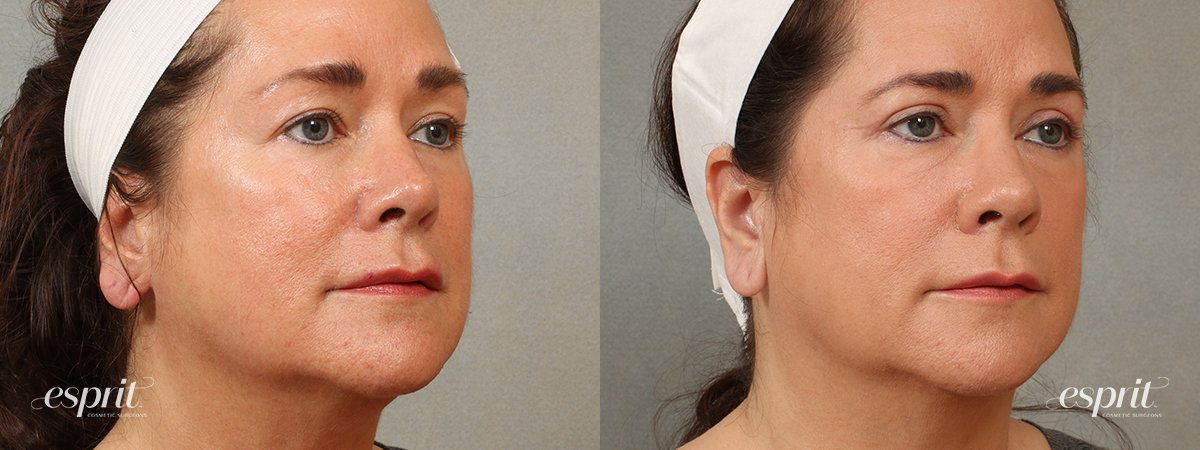 Case 1706 eyelids before and after right oblique view esprit® cosmetic surgeons
