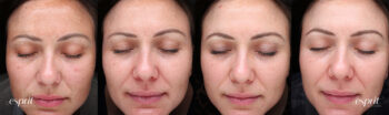 Case 3000 Obagi NuDerm Before and After Collage
