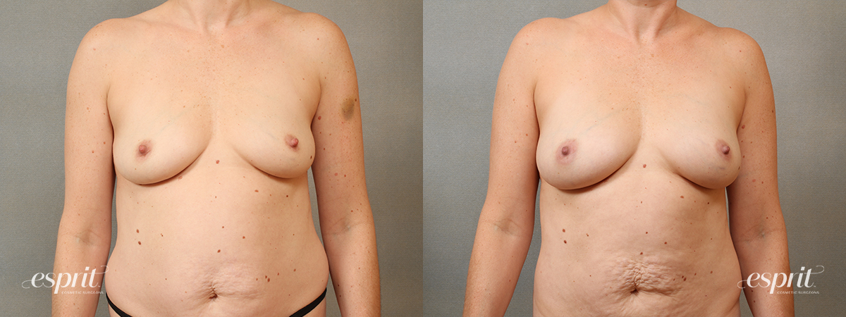 Case 1685 fat grafting before and after front view esprit® cosmetic surgeons