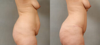 Case 1700 Tummy Tuck Before and After Right Side View