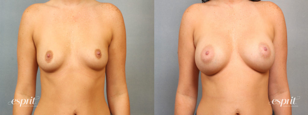 Breast Augmentation Page Slider Patient 2 Before and After Front View