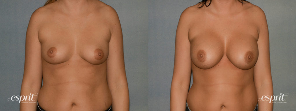 Breast Augmentation Page Slider Patient 1 Before and After Front View