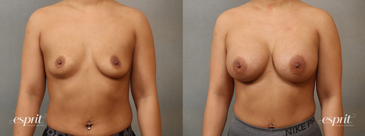 Case 4101 Breast Augmentation Before and After Front View
