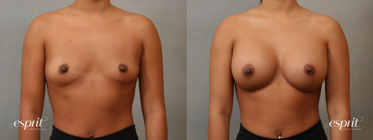 Case 4102 breast augmentation before and after front view esprit® cosmetic surgeons