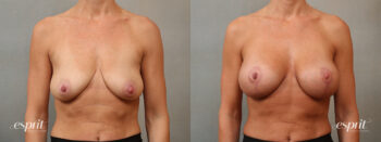 Case 5101 Breast Augmentation & Lift Before and After Front View
