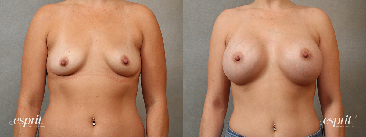Case 4103 Breast Augmentation Before and After Front View