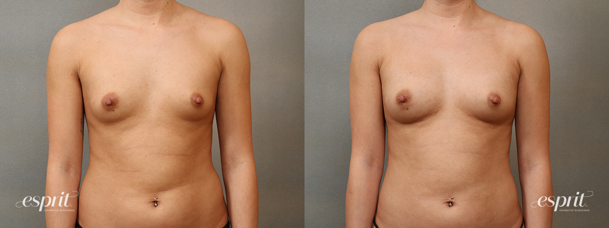 Case 2201 before and after front view esprit® cosmetic surgeons