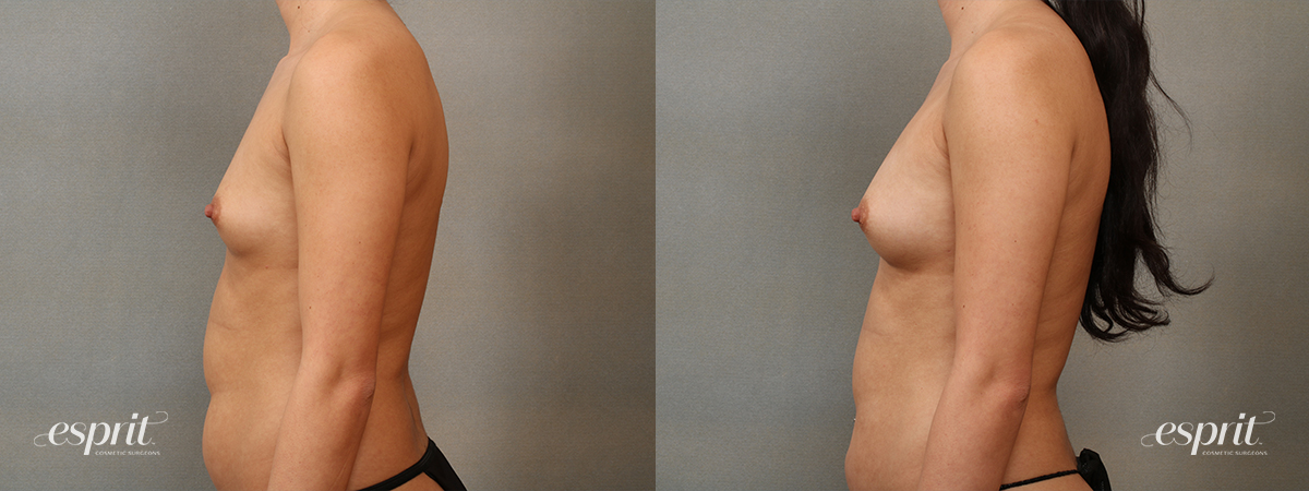 Case 2201 before and after left side view esprit® cosmetic surgeons
