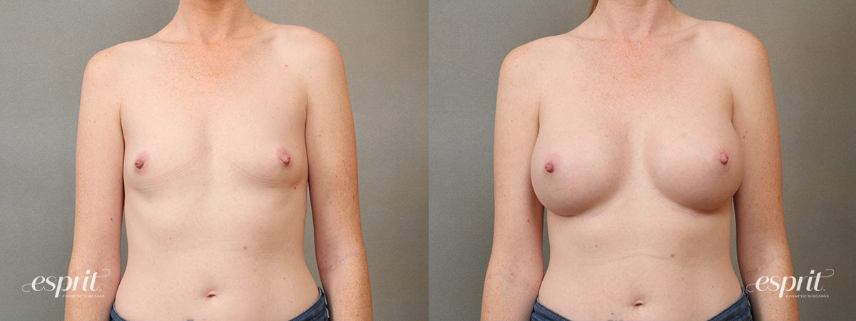Case 4104 Breast Augmentation Before and After Front View